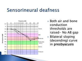  Both air and bone
conduction
thresholds are
raised- No AB gap
 Bilateral sloping
(decending) curve
in presbyacusis
 