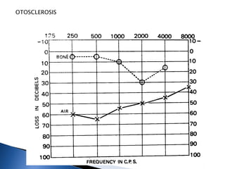 OTOSCLEROSIS
 
