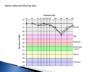 Noise induced hearing loss
 