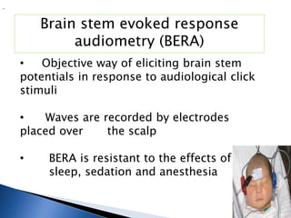 .
Brain stem evoked response
audiometry (BERA)
• Objective way of eliciting brain stem
potentials in response to audiological click
stimuli
• Waves are recorded by electrodes
placed over the scalp
• BERA is resistant to the effects of
sleep, sedation and anesthesia
 