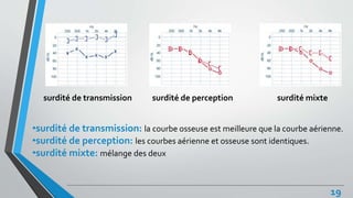 surdité de transmission surdité de perception surdité mixte
•surdité de transmission: la courbe osseuse est meilleure que la courbe aérienne.
•surdité de perception: les courbes aérienne et osseuse sont identiques.
•surdité mixte: mélange des deux
19
 