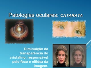 Patologias oculares:Patologias oculares: CATARATACATARATA
Diminuição da
transparência do
cristalino, responsável
pelo foco e nitidez da
imagem.
 