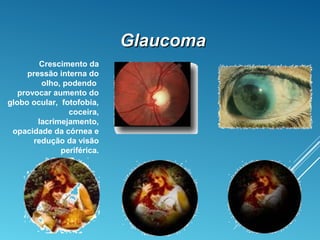 GlaucomaGlaucoma
Crescimento da
pressão interna do
olho, podendo
provocar aumento do
globo ocular, fotofobia,
coceira,
lacrimejamento,
opacidade da córnea e
redução da visão
periférica.
 