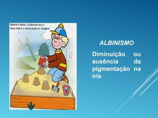 ALBINISMO
Diminuição ou
ausência da
pigmentação na
íris
 