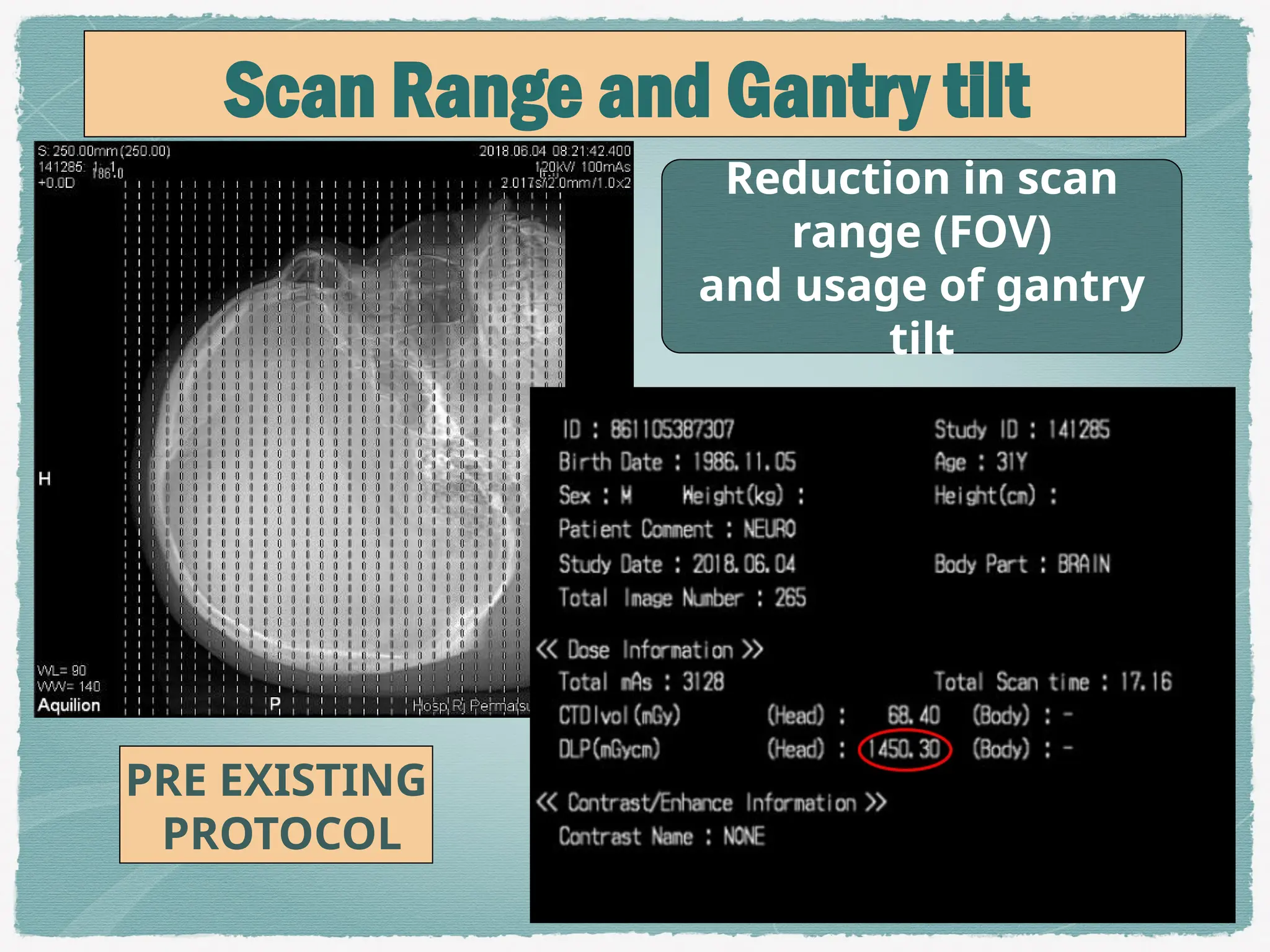 AUDIT ON RADIATION DOSE OF ADULT CT BRAIN IN RADIOLOGY DEPARTMENT ...
