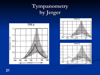 Tympanometry by Jerger 