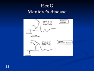 EcoG Meniere’s disease 