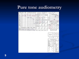 Pure tone audiometry 