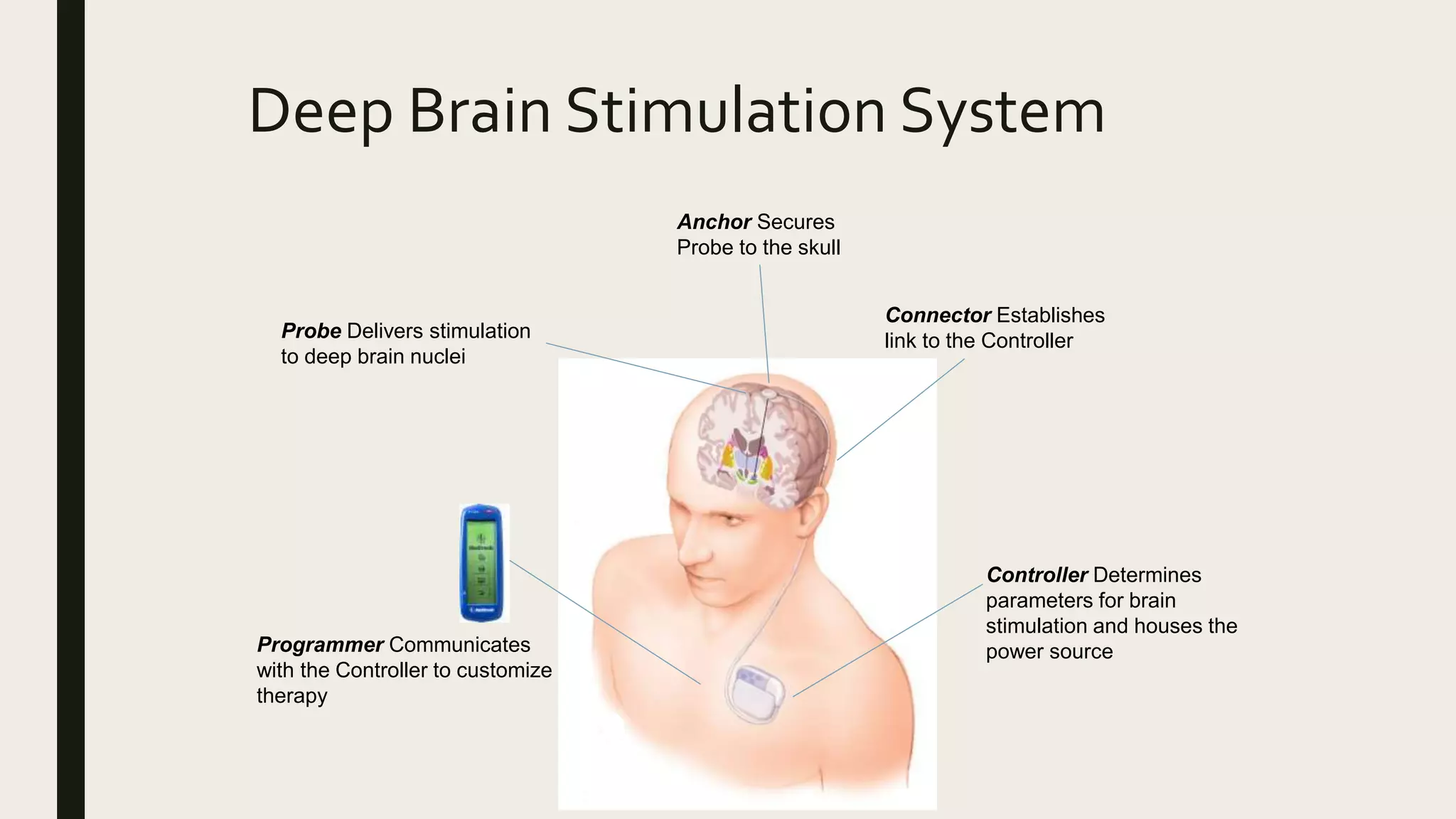 Probe Delivers stimulation
to deep brain nuclei
Anchor Secures
Probe to the skull
Connector Establishes
link to the Controller
Programmer Communicates
with the Controller to customize
therapy
Controller Determines
parameters for brain
stimulation and houses the
power source
Deep Brain Stimulation System
 