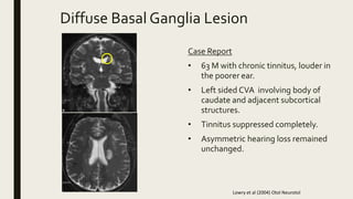 Diffuse Basal Ganglia Lesion
Case Report
• 63 M with chronic tinnitus, louder in
the poorer ear.
• Left sided CVA involving body of
caudate and adjacent subcortical
structures.
• Tinnitus suppressed completely.
• Asymmetric hearing loss remained
unchanged.
Lowry et al (2004) Otol Neurotol
 