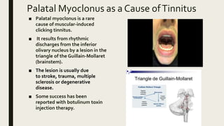 Palatal Myoclonus as a Cause ofTinnitus
■ Palatal myoclonus is a rare
cause of muscular-induced
clicking tinnitus.
■ It results from rhythmic
discharges from the inferior
olivary nucleus by a lesion in the
triangle of the Guillain-Mollaret
(brainstem).
■ The lesion is usually due
to stroke, trauma, multiple
sclerosis or degenerative
disease.
■ Some success has been
reported with botulinum toxin
injection therapy.
 