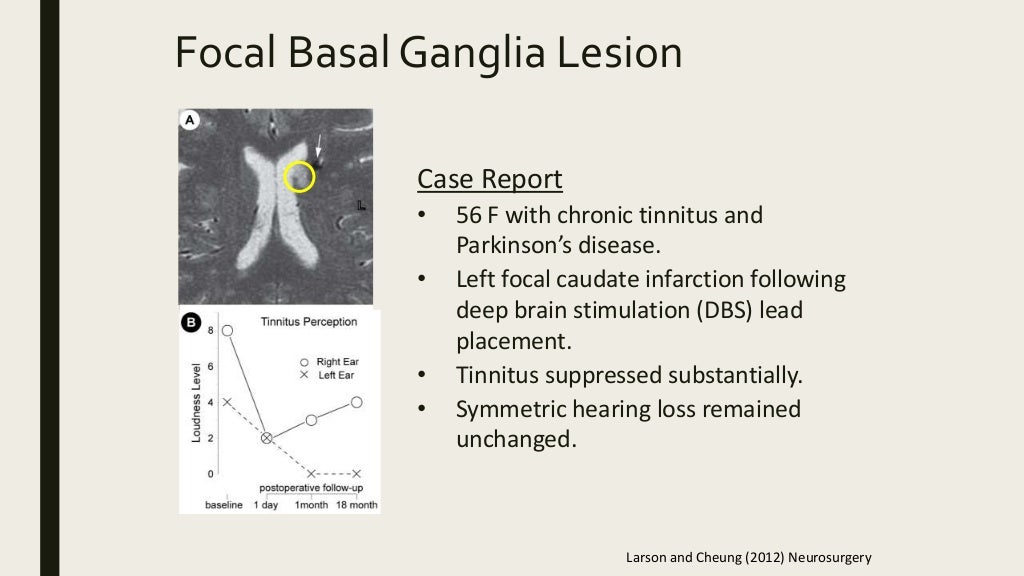Auditory Hallucinations