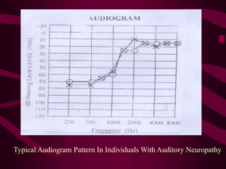 Typical Audiogram Pattern In Individuals With Auditory Neuropathy
 