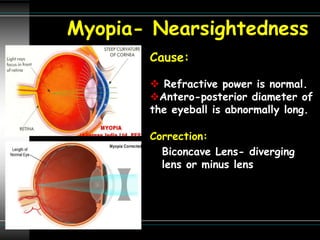 Myopia- Nearsightedness
Cause:
 Refractive power is normal.
Antero-posterior diameter of
the eyeball is abnormally long.
Correction:
Biconcave Lens- diverging
lens or minus lens
 