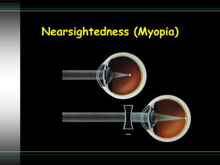 Nearsightedness (Myopia)
 