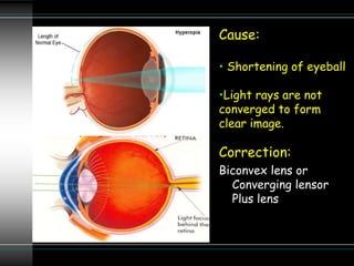Cause:
• Shortening of eyeball
•Light rays are not
converged to form
clear image.
Correction:
Biconvex lens or
Converging lensor
Plus lens
 