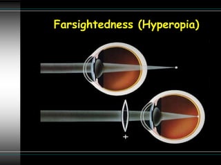 Farsightedness (Hyperopia)
 