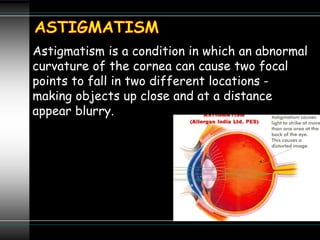 Astigmatism is a condition in which an abnormal
curvature of the cornea can cause two focal
points to fall in two different locations -
making objects up close and at a distance
appear blurry.
 