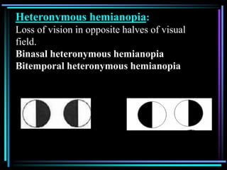 Heteronymous hemianopia:
Loss of vision in opposite halves of visual
field.
Binasal heteronymous hemianopia
Bitemporal heteronymous hemianopia
 