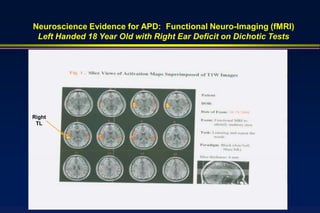Neuroscience Evidence for APD: Functional Neuro-Imaging (fMRI)
 Left Handed 18 Year Old with Right Ear Deficit on Dichotic Tests




Right
 TL
 