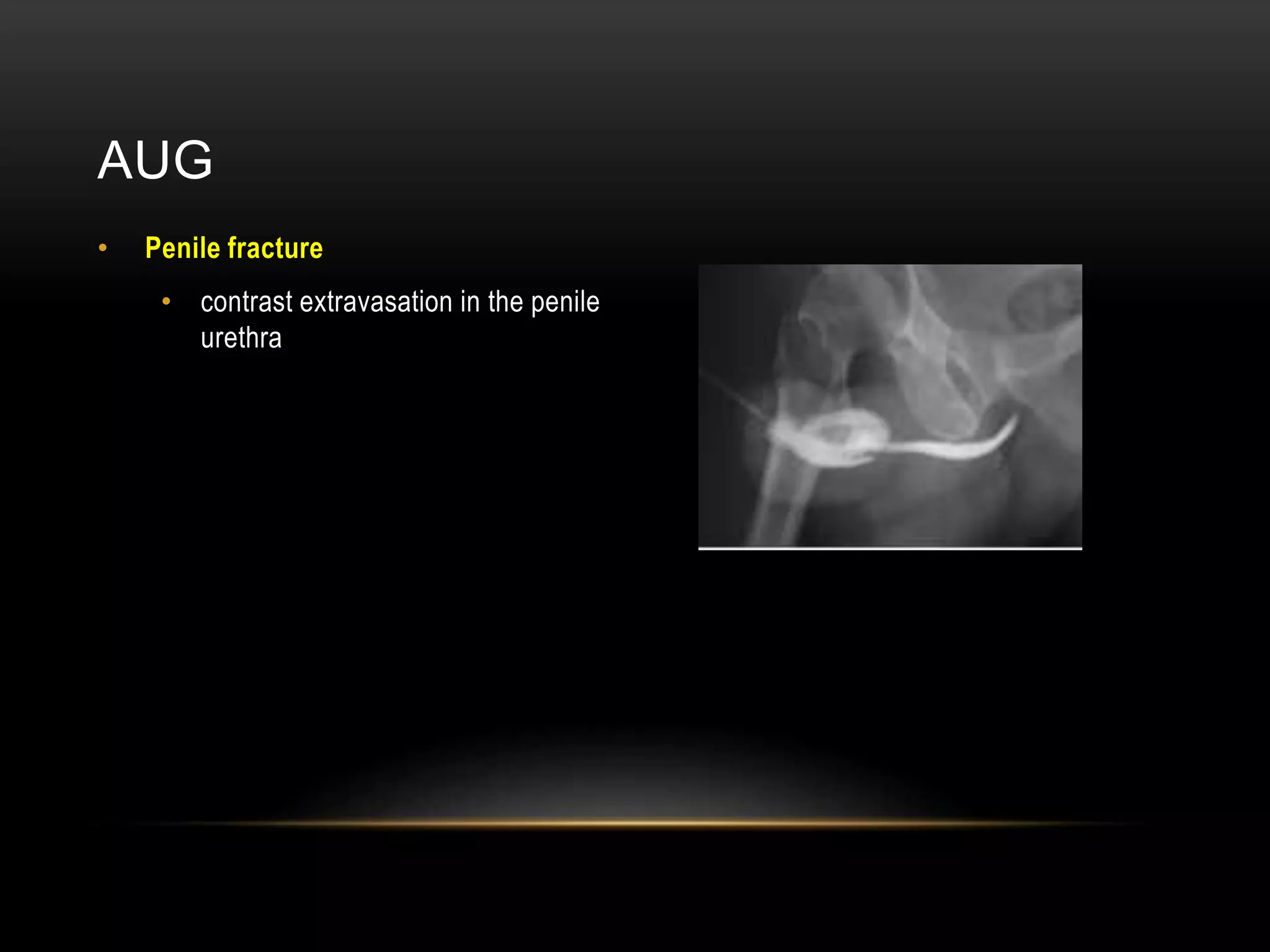 AUG
• Penile fracture
• contrast extravasation in the penile
urethra
 