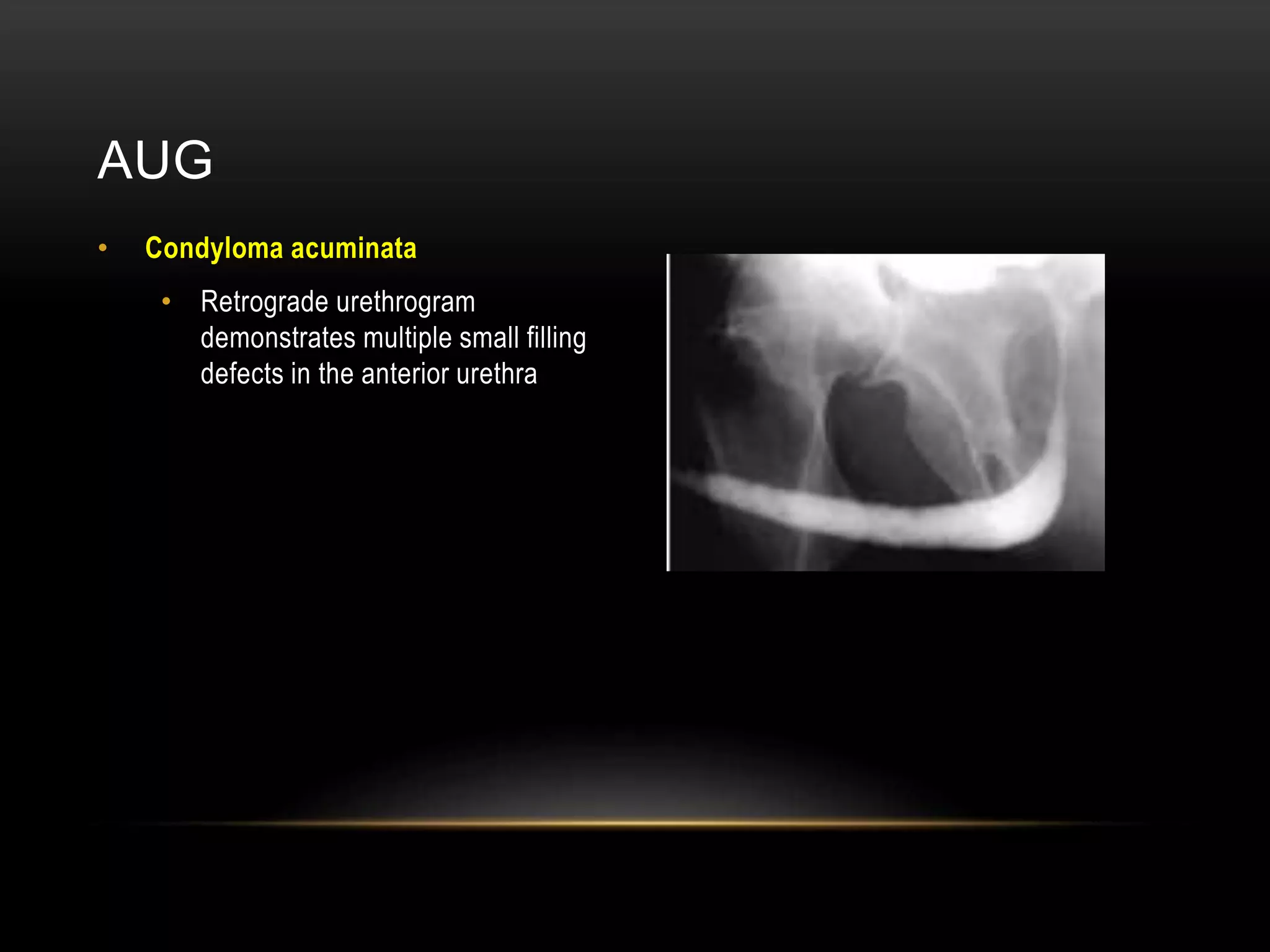 AUG
• Condyloma acuminata
• Retrograde urethrogram
demonstrates multiple small filling
defects in the anterior urethra
 