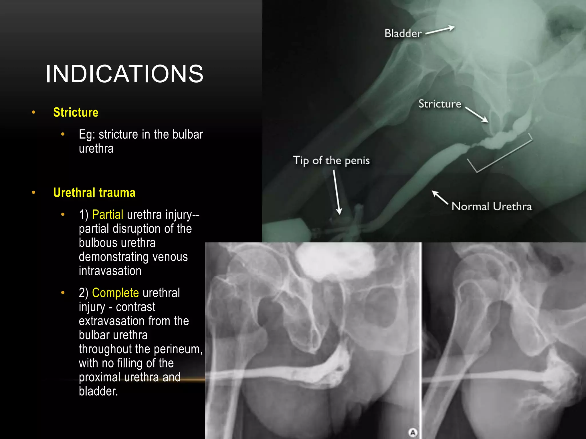 INDICATIONS
• Stricture
• Eg: stricture in the bulbar
urethra
• Urethral trauma
• 1) Partial urethra injury--
partial disruption of the
bulbous urethra
demonstrating venous
intravasation
• 2) Complete urethral
injury - contrast
extravasation from the
bulbar urethra
throughout the perineum,
with no filling of the
proximal urethra and
bladder.
 