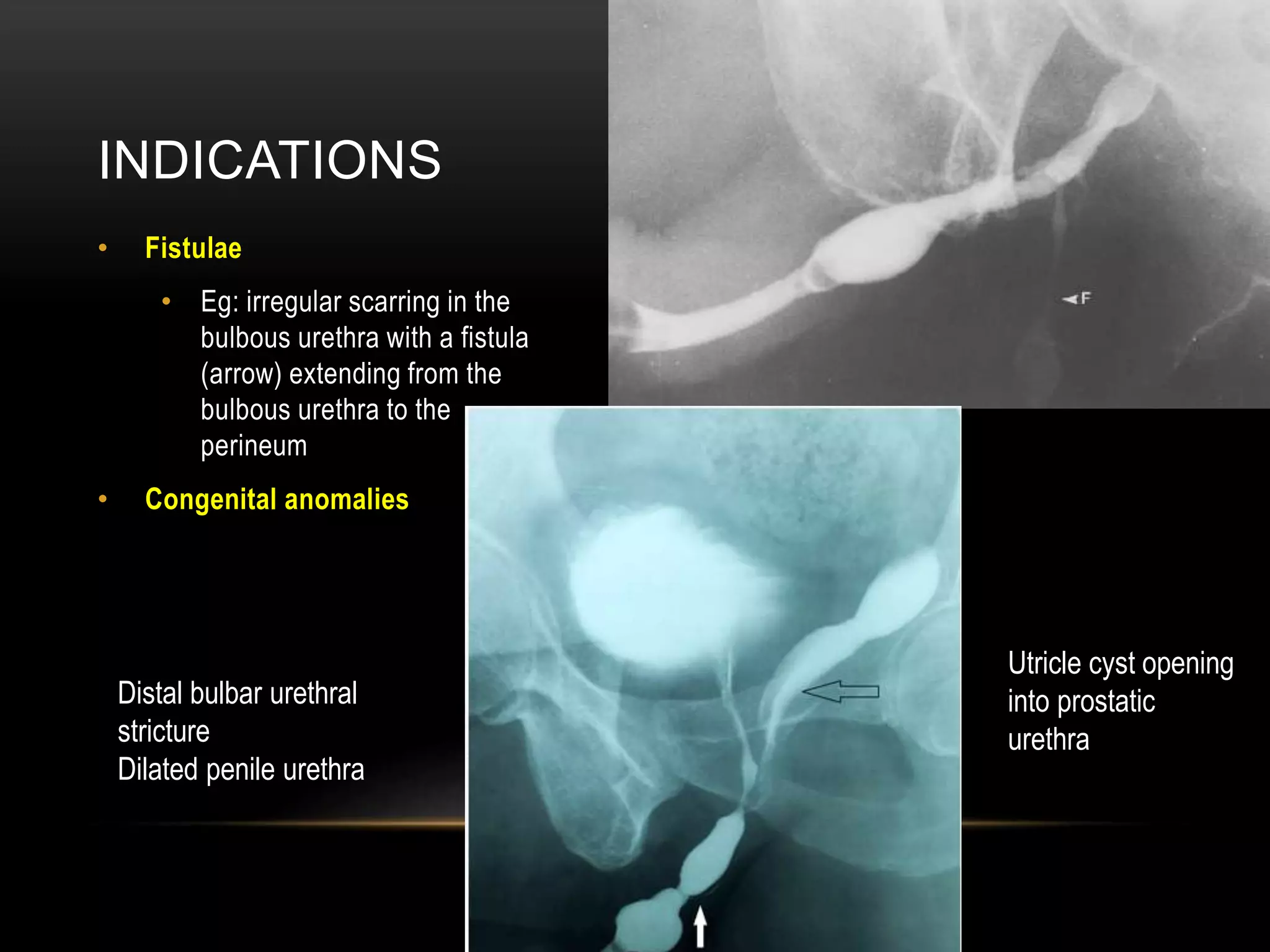 INDICATIONS
• Fistulae
• Eg: irregular scarring in the
bulbous urethra with a fistula
(arrow) extending from the
bulbous urethra to the
perineum
• Congenital anomalies
Distal bulbar urethral
stricture
Dilated penile urethra
Utricle cyst opening
into prostatic
urethra
 