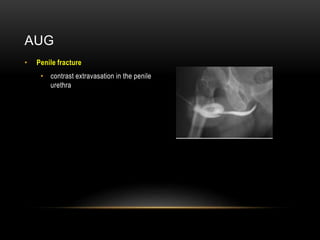 AUG
• Penile fracture
• contrast extravasation in the penile
urethra
 