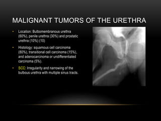 MALIGNANT TUMORS OF THE URETHRA
• Location: Bulbomembranous urethra
(60%), penile urethra (30%) and prostatic
urethra (10%) (10)
• Histology: squamous cell carcinoma
(80%), transitional cell carcinoma (15%),
and adenocarcinoma or undifferentiated
carcinoma (5%).
• SCC: Irregularity and narrowing of the
bulbous urethra with multiple sinus tracts.
 