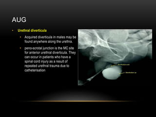 AUG
• Urethral diverticula
• Acquired diverticula in males may be
found anywhere along the urethra.
• peno-scrotal junction is the MC site
for anterior urethral diverticula. They
can occur in patients who have a
spinal cord injury as a result of
repeated urethral trauma due to
catheterisation
 