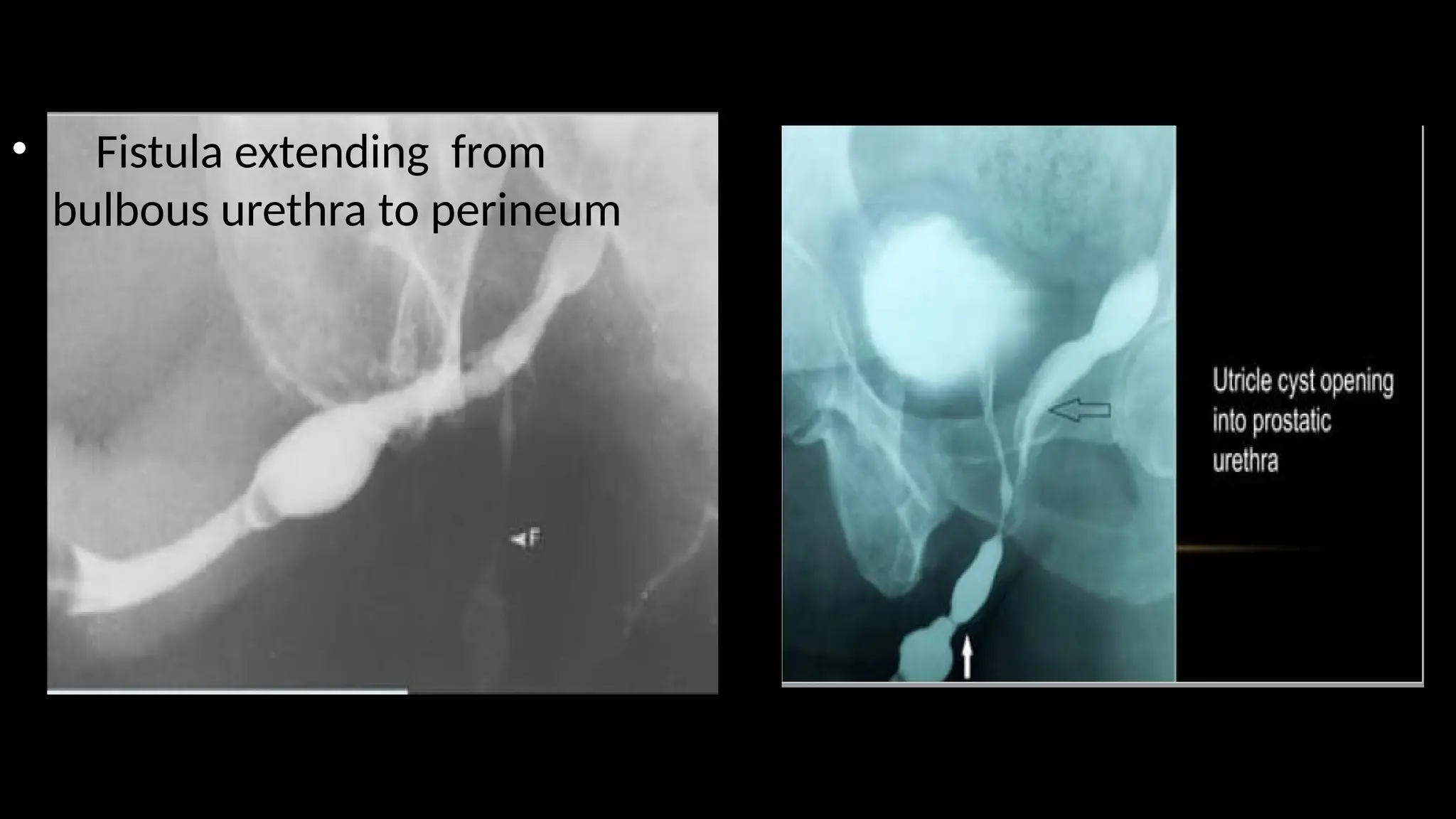 • Fistula extending from
bulbous urethra to perineum
 