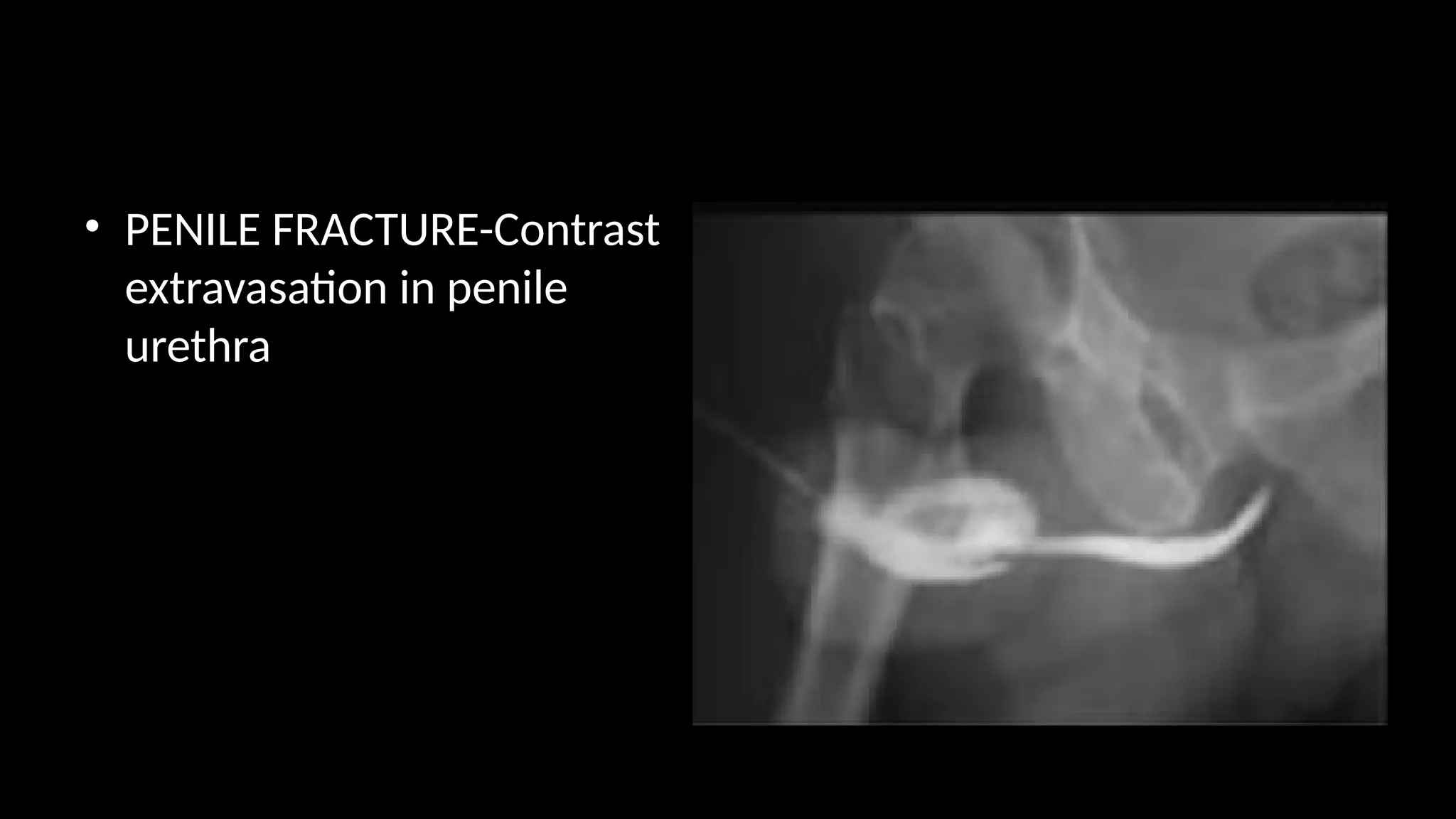 • PENILE FRACTURE-Contrast
extravasation in penile
urethra
 