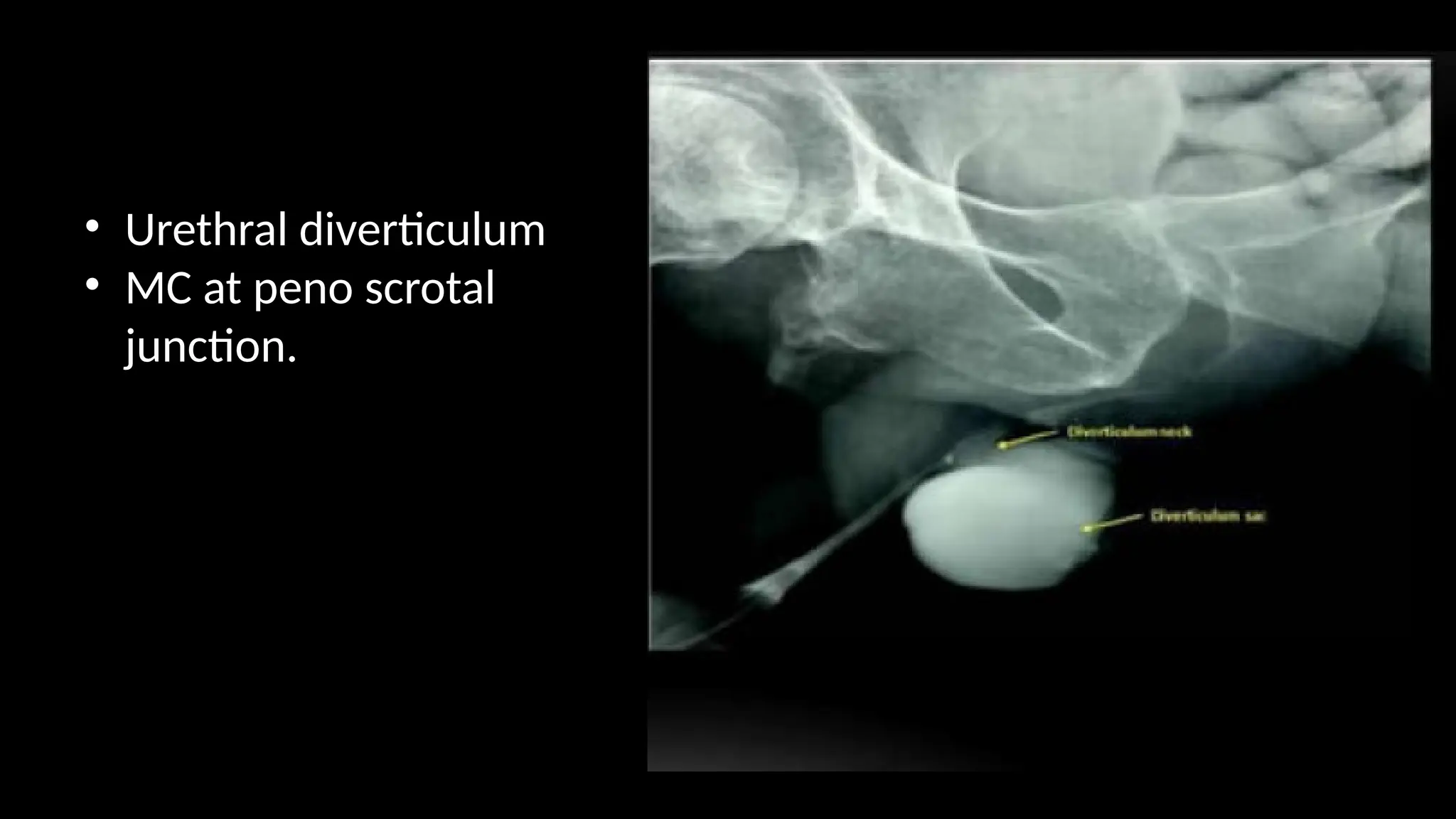 • Urethral diverticulum
• MC at peno scrotal
junction.
 