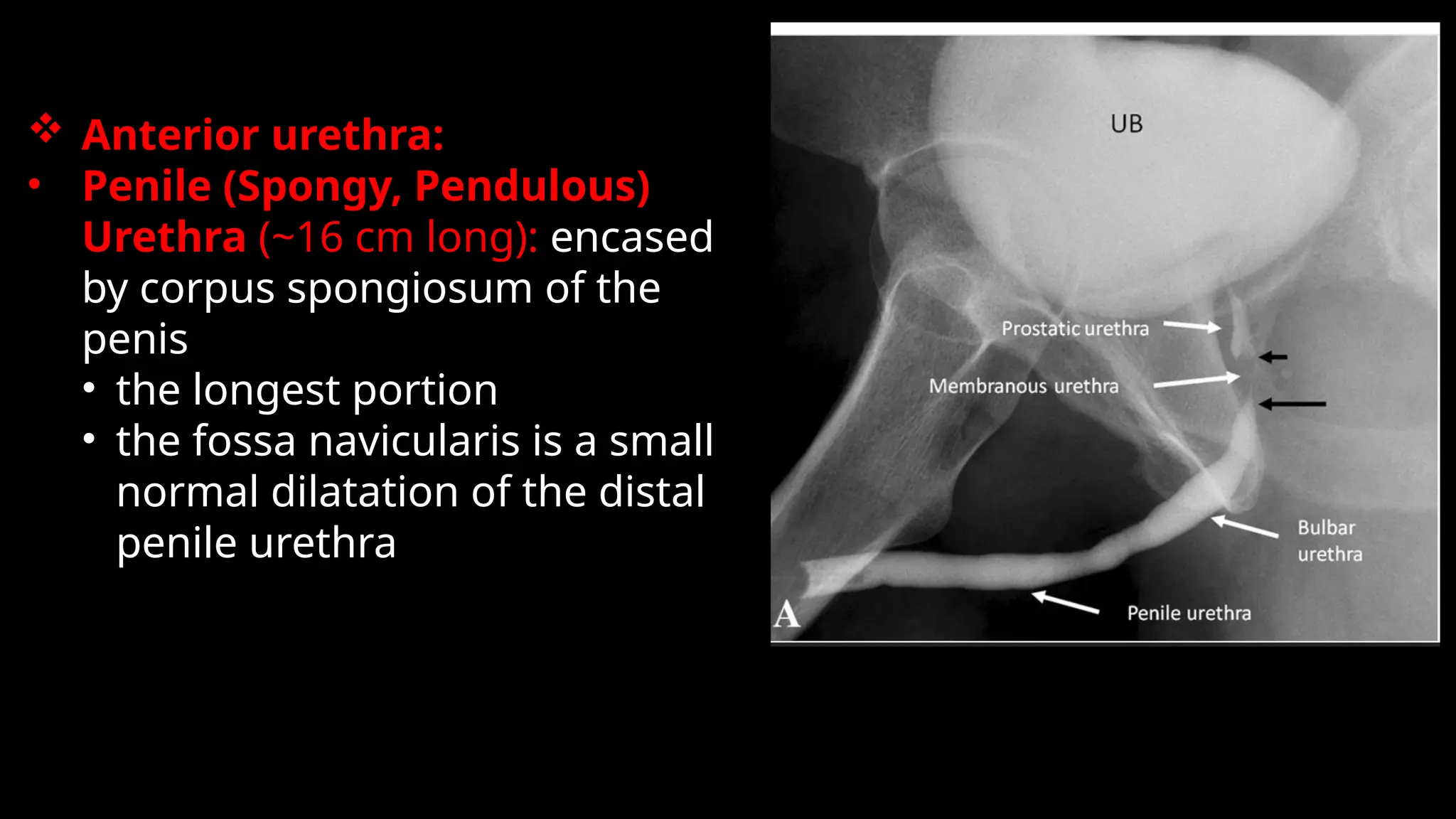  Anterior urethra:
• Penile (Spongy, Pendulous)
Urethra (~16 cm long): encased
by corpus spongiosum of the
penis
• the longest portion
• the fossa navicularis is a small
normal dilatation of the distal
penile urethra
 