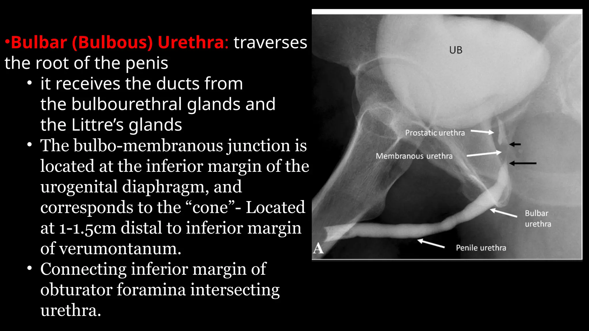 •Bulbar (Bulbous) Urethra: traverses
the root of the penis
• it receives the ducts from
the bulbourethral glands and
the Littre’s glands
• The bulbo-membranous junction is
located at the inferior margin of the
urogenital diaphragm, and
corresponds to the “cone”- Located
at 1-1.5cm distal to inferior margin
of verumontanum.
• Connecting inferior margin of
obturator foramina intersecting
urethra.
 