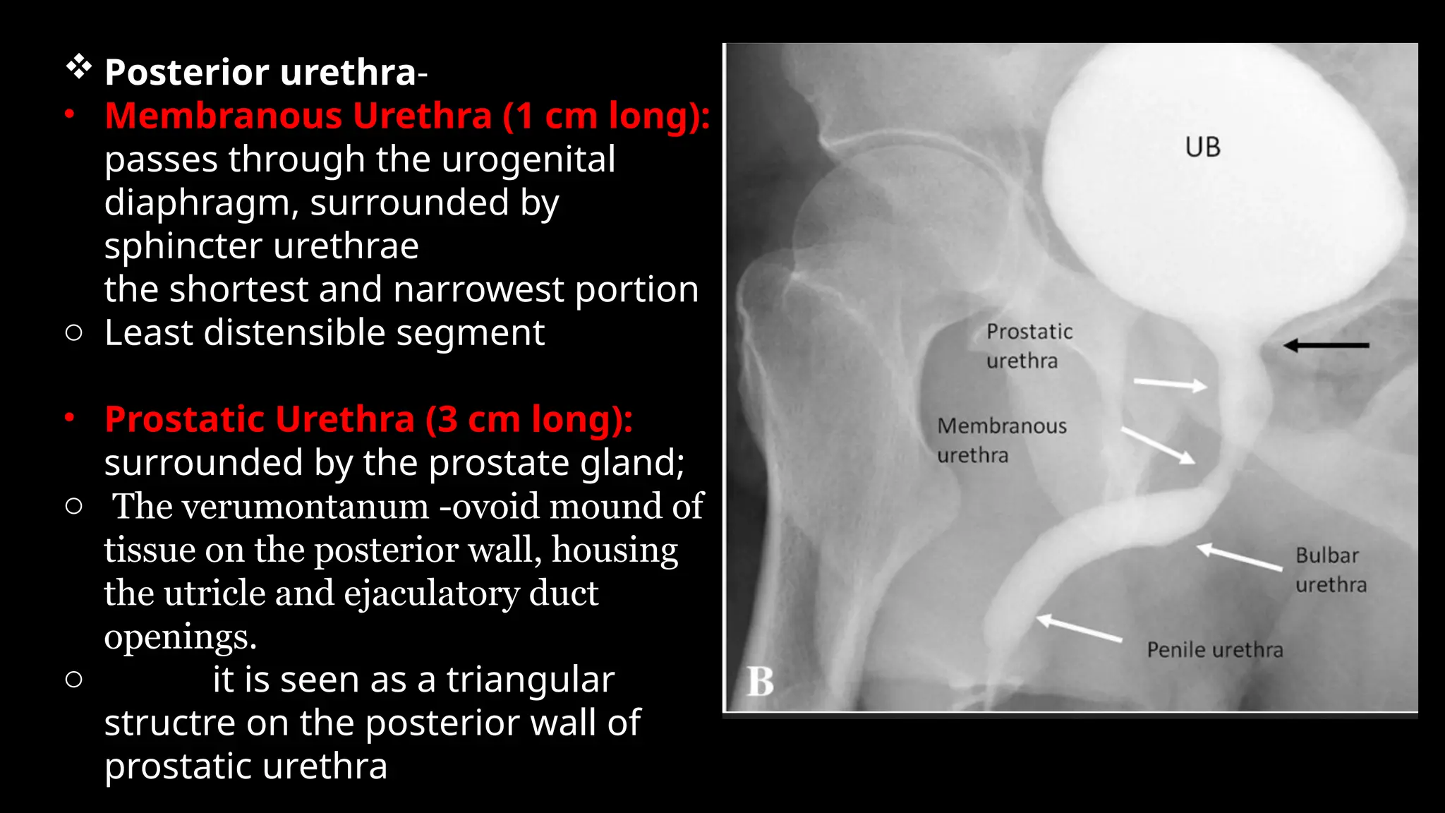  Posterior urethra-
• Membranous Urethra (1 cm long):
passes through the urogenital
diaphragm, surrounded by
sphincter urethrae
the shortest and narrowest portion
o Least distensible segment
• Prostatic Urethra (3 cm long):
surrounded by the prostate gland;
o The verumontanum -ovoid mound of
tissue on the posterior wall, housing
the utricle and ejaculatory duct
openings.
o it is seen as a triangular
structre on the posterior wall of
prostatic urethra
 