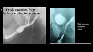 • Fistula extending from
bulbous urethra to perineum
 