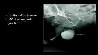 • Urethral diverticulum
• MC at peno scrotal
junction.
 