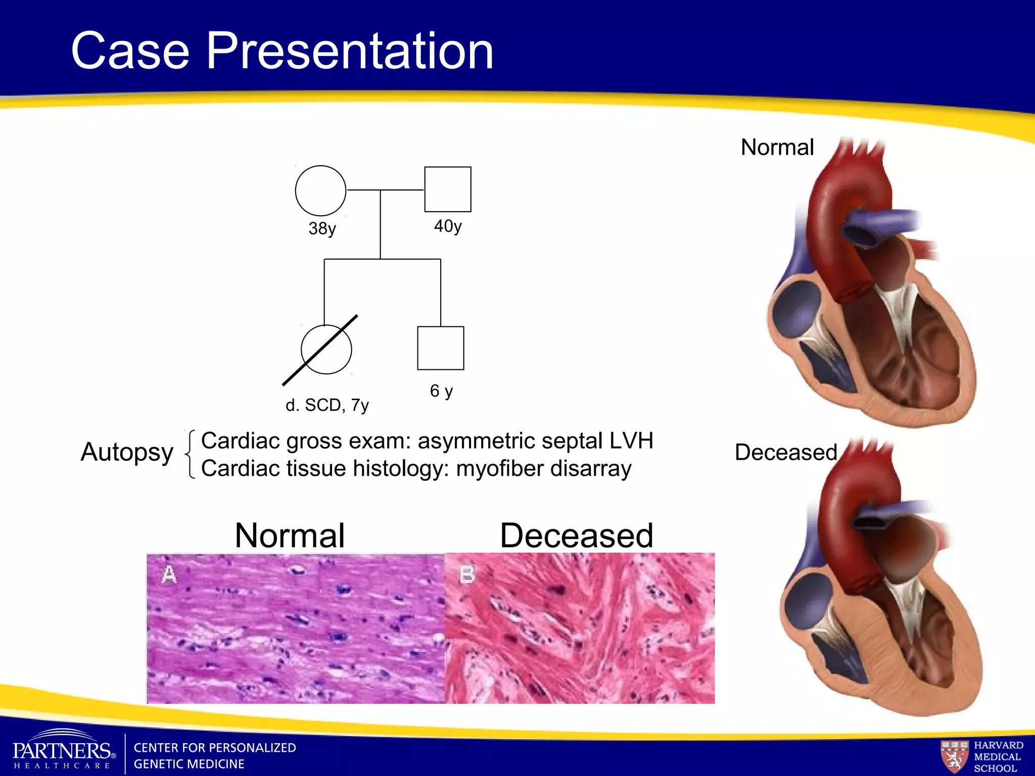 d. SCD, 7y
38y
Case Presentation
Cardiac gross exam: asymmetric septal LVH
Cardiac tissue histology: myofiber disarray
Autopsy
40y
6 y
Normal Deceased
Normal
Deceased
 