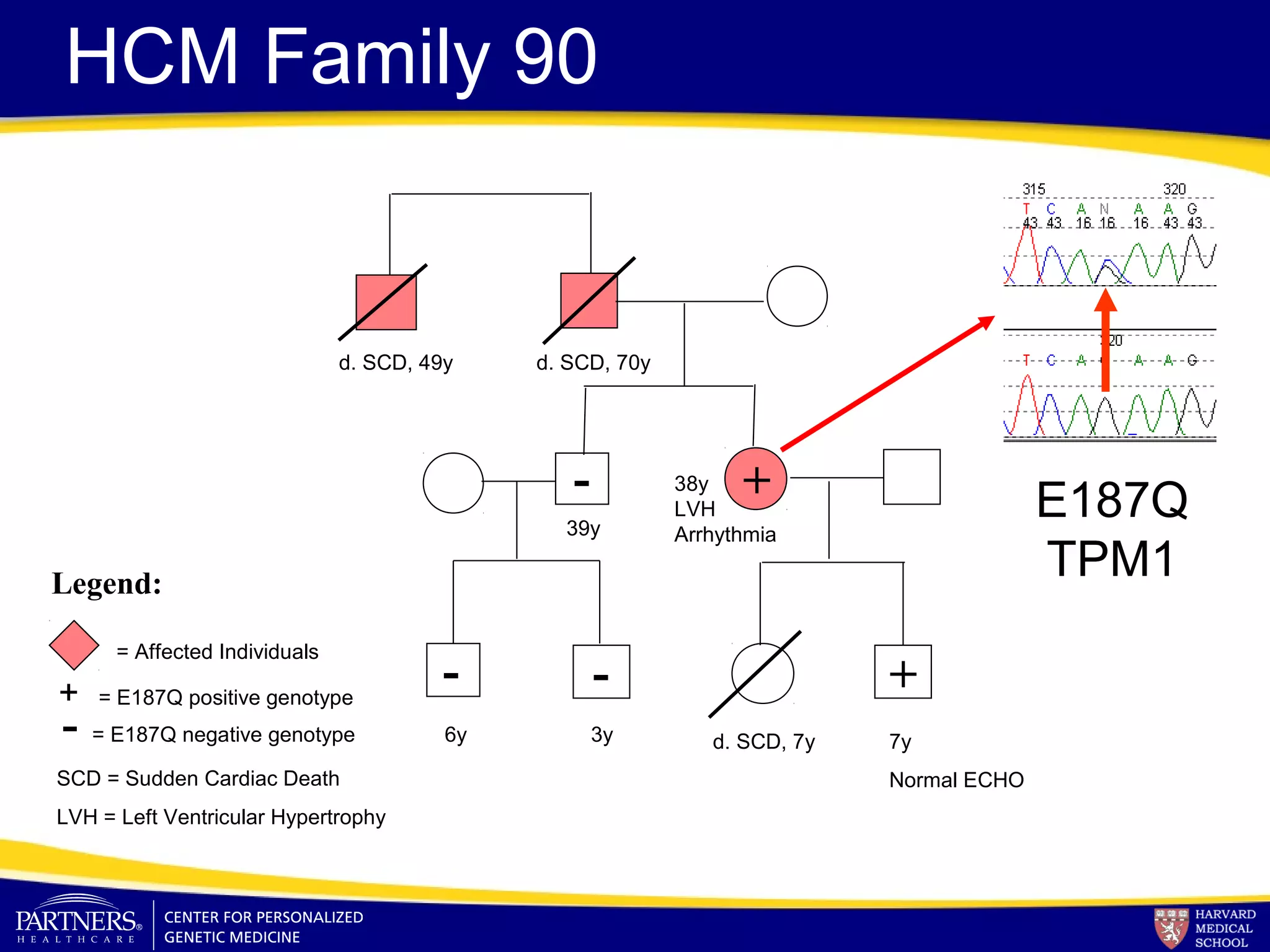 HCM Family 90
Legend:
= Affected Individuals
+ = E187Q positive genotype
- = E187Q negative genotype
d. SCD, 49y d. SCD, 70y
39y
d. SCD, 7y 7y
Normal ECHO
6y 3y
SCD = Sudden Cardiac Death
LVH = Left Ventricular Hypertrophy
+
+- -
- 38y
LVH
Arrhythmia
E187Q
TPM1
 
