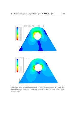 º Ö ÒÙÒ × Ù Ò×Ø × Ñ º ¾º½ ´ µ ½¿¿
1
2
3 1
2
3
MISES VALUE
+9.07E-01
+1.77E+01
+3.45E+01
+5.12E+01
+6.80E+01
+8.48E+01
+1.02E+02
+1.18E+02
+1.35E+02
+1.52E+02
+1.69E+02
+1.85E+02
+2.02E+02
+2.19E+02
Minimum value = 0.9072 at node 666
Maximum value = 219.0 at node 578
1
2
3 1
2
3
SP2 VALUE
-9.90E+00
+7.57E+00
+2.50E+01
+4.25E+01
+6.00E+01
+7.75E+01
+9.49E+01
+1.12E+02
+1.30E+02
+1.47E+02
+1.65E+02
+1.82E+02
+2.00E+02
+2.17E+02
Minimum value = -9.899 at node 918
Maximum value = 217.3 at node 526
Ð ÙÒ º ¿ Î Ö Ð ×Ô ÒÒÙÒ Ò ËÎ ÙÒ À ÙÔØ×Ô ÒÒÙÒ ËÈ¾ Ò Ö
Ð Ò Ö ÙÒ ¸ ¼¸ Ö ¿½ ÑÑ¸ Ò ¼ Æ»ÑÑ
¾
¸ ¼¸¿ × ¼¸½ ÑÑ
¼¸ ¬ ¿¼Æ
 