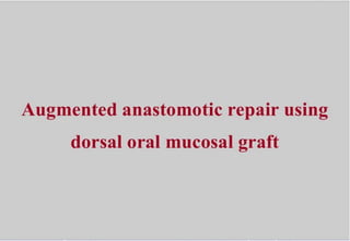 Augmented anastomotic repair  sing dorsal oral mucosal graft