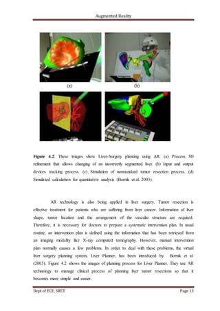 Augmented Reality
Dept of ECE, SRET Page 13
Figure 4.2: These images show Liver-Surgery planning using AR. (a) Process 3D
refinement that allows changing of an incorrectly segmented liver. (b) Input and output
devices tracking process. (c) Simulation of nonstandard tumor resection process. (d)
Simulated calculation for quantitative analysis (Bornik et al. 2003).
AR technology is also being applied in liver surgery. Tumor resection is
effective treatment for patients who are suffering from liver cancer. Information of liver
shape, tumor location and the arrangement of the vascular structure are required.
Therefore, it is necessary for doctors to prepare a systematic intervention plan. In usual
routine, an intervention plan is defined using the information that has been retrieved from
an imaging modality like X-ray computed tomography. However, manual intervention
plan normally causes a few problems. In order to deal with these problems, the virtual
liver surgery planning system, Liver Planner, has been introduced by Bornik et al.
(2003). Figure 4.2 shows the images of planning process for Liver Planner. They use AR
technology to manage clinical process of planning liver tumor resections so that it
becomes more simple and easier.
 
