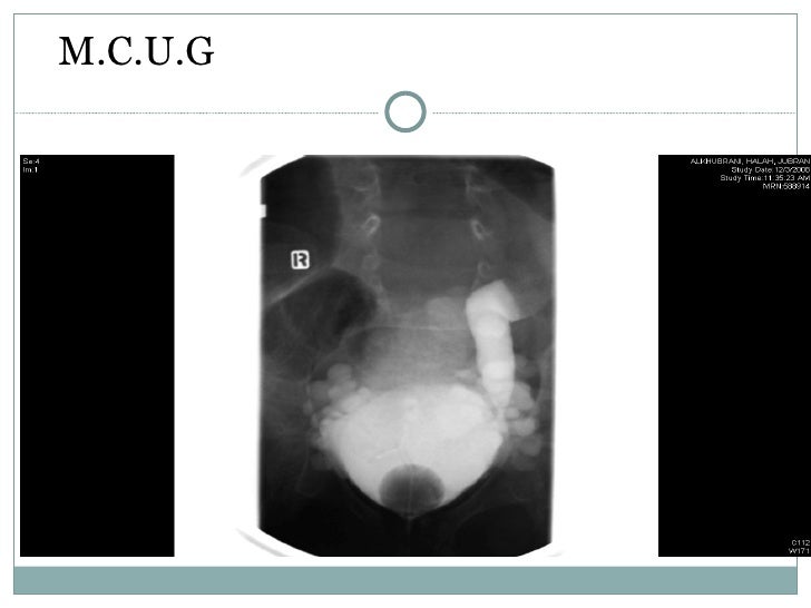 combined MontiGhonaim technique as urinary stoma