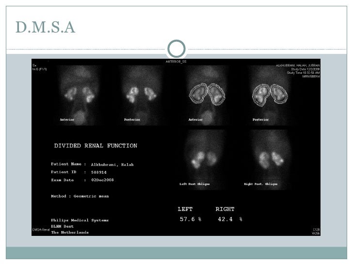 combined MontiGhonaim technique as urinary stoma