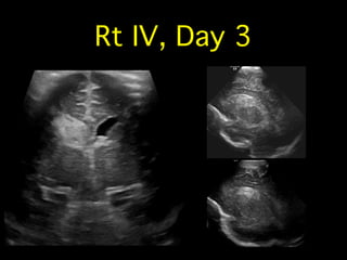 Neonatal Cranial & Spinal Ultrasound | PDF