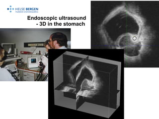 Endoscopic ultrasound    - 3D in the stomach 