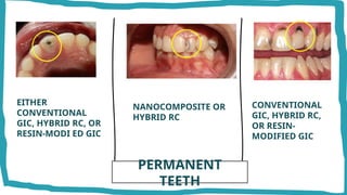 Mod Teeth MODIFICATION IN CAVITY PREPARATION FOR VARIOUS RESTORATIVE MATERIALS IN ...