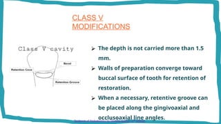 Mod Teeth MODIFICATION IN CAVITY PREPARATION FOR VARIOUS RESTORATIVE MATERIALS IN ...